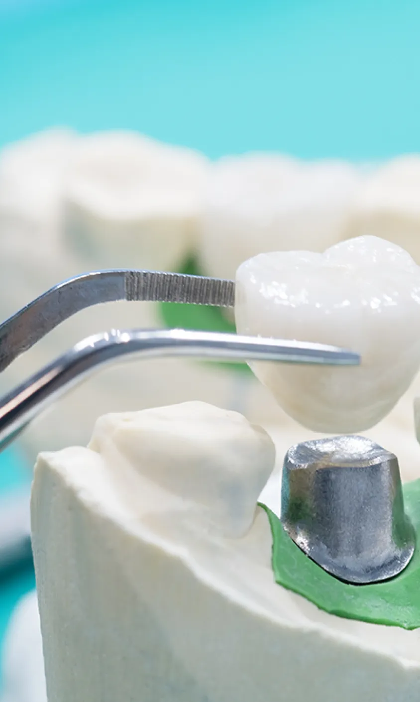 日本口腔インプラント学会専修医による治療