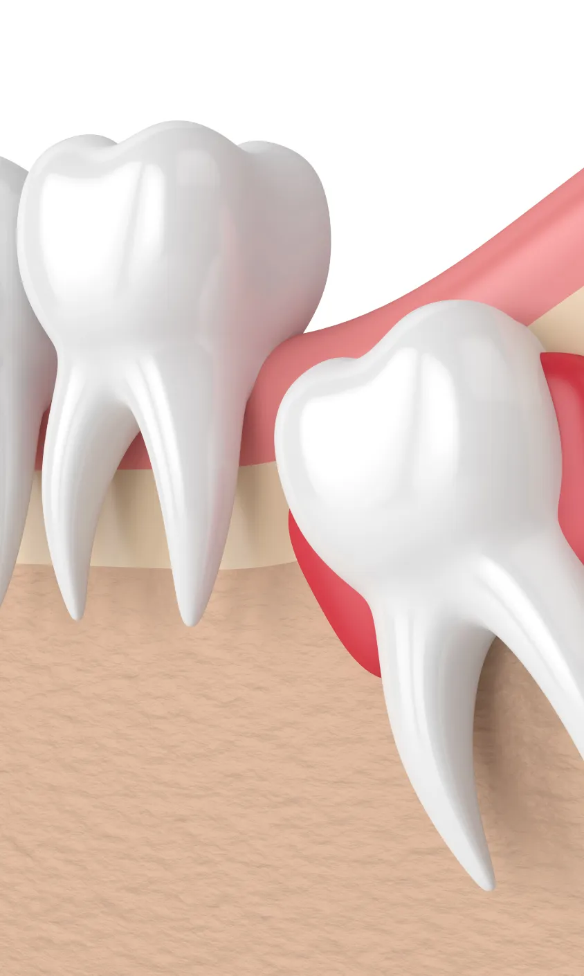 痛み・腫れに配慮した親知らず抜歯