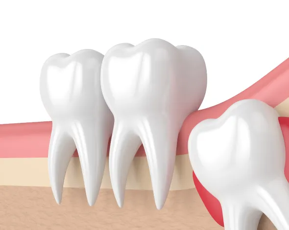 痛み・腫れに配慮した親知らず抜歯